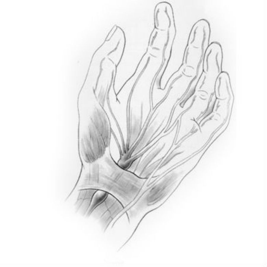 Carpal Tunnel Syndrom